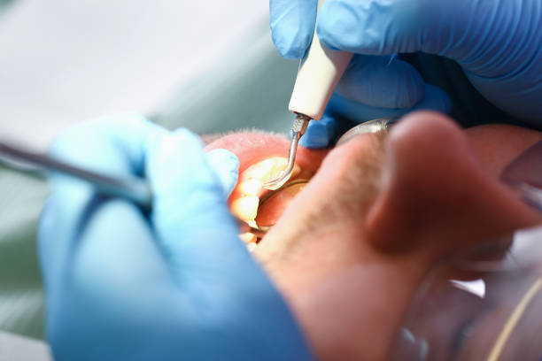 Best Emergency Dentist for Lost Fillings or Crowns in Murphy, TX